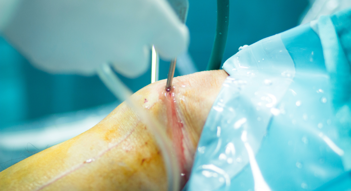 robotic-knee-replacement-vs-conventional-surgery